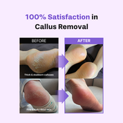 Foot Softener At-home Kit: Foot File & Callus Softener Spray
